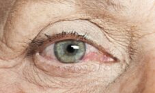 Qué es el síndrome del ojo seco?