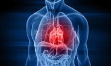 Qué es una arritmia cardiaca