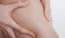 ¿Por qué salen varices?